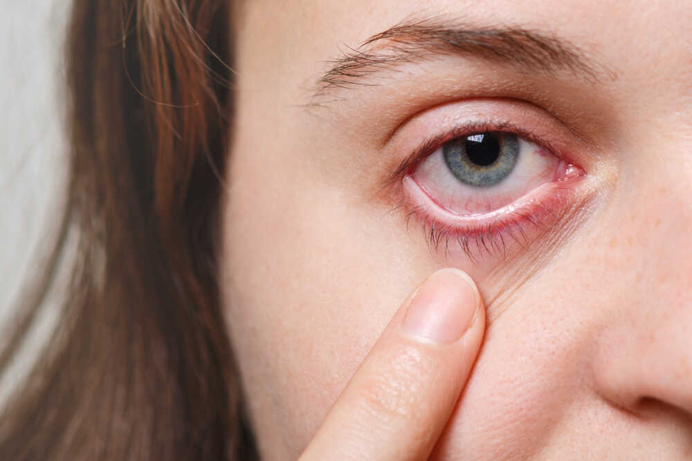 Zapalenie oka i rogówki u kobiety w średnim wieku