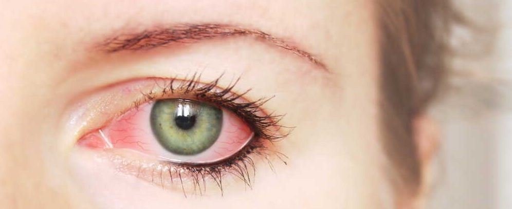 zapalenie spojówek, czerwone oczy u kobiety w średnim wieku